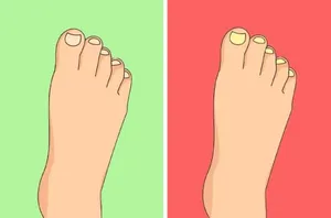 زردی ناخن؛ چه باید بکنیم؟